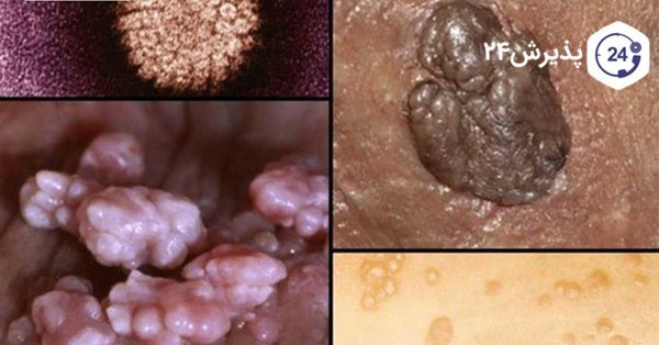  تجربه من از درمان زگیل تناسلی