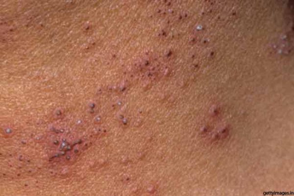  تجربه من از درمان زگیل تناسلی