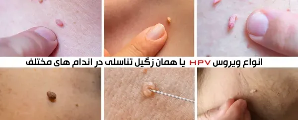  تجربه من از درمان زگیل تناسلی