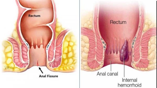  درمان قطعی بواسیر هموروئید شقاق فیشر بدون دارو و جراحی