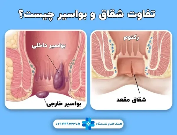  درمان قطعی بواسیر هموروئید شقاق فیشر بدون دارو و جراحی