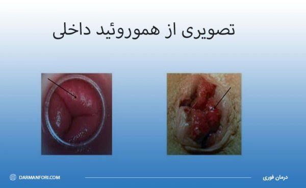  درمان قطعی بواسیر هموروئید شقاق فیشر بدون دارو و جراحی