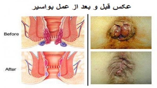 چه زمانی بواسیر نیاز به عمل دارد؟