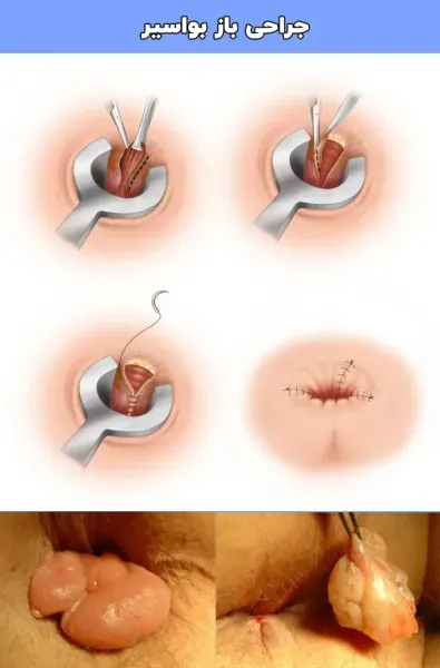  چه زمانی بواسیر نیاز به عمل دارد؟