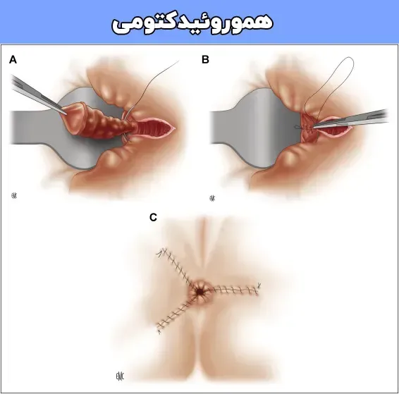  چه زمانی بواسیر نیاز به عمل دارد؟