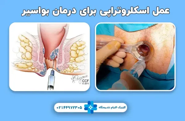  سوالات متداول عمل بواسیر