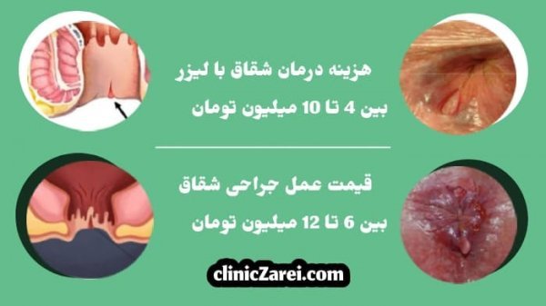  فیلم عکس عمل بواسیر هموروئید