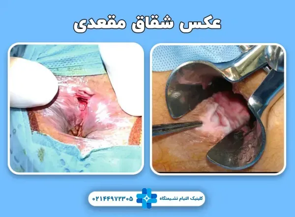  فیلم عکس عمل بواسیر هموروئید