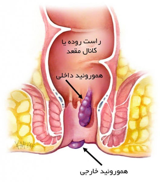  برای هموروئید پیش چه دکتری باید رفت؟