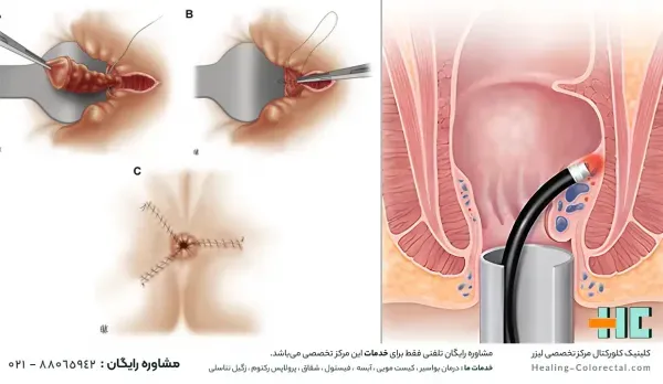  برای هموروئید پیش چه دکتری باید رفت؟