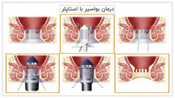  برای هموروئید پیش چه دکتری باید رفت؟