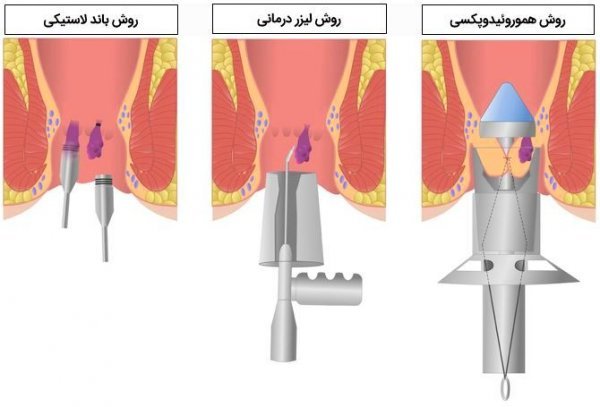  برای هموروئید پیش چه دکتری باید رفت؟