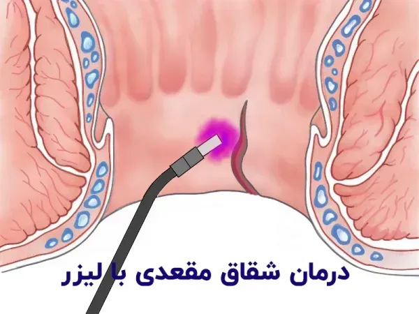  درمان بواسیر یا هموروئید با لیزر