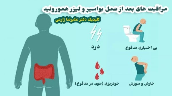  درمان بواسیر یا هموروئید با لیزر