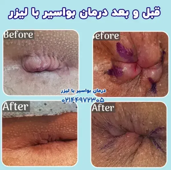  درمان بواسیر یا هموروئید با لیزر