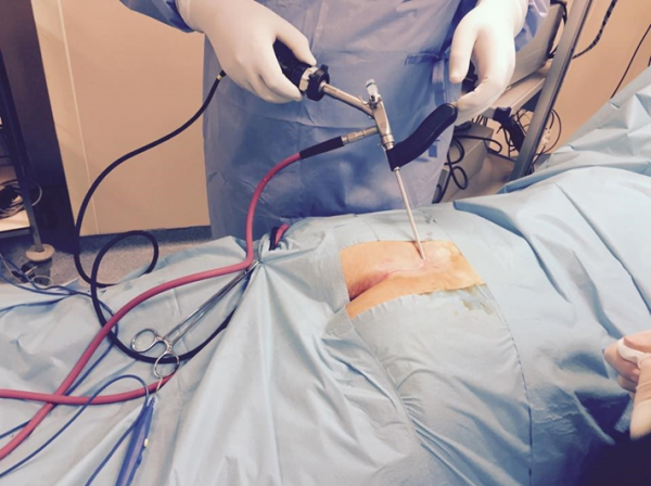  درمان بواسیر یا هموروئید با لیزر