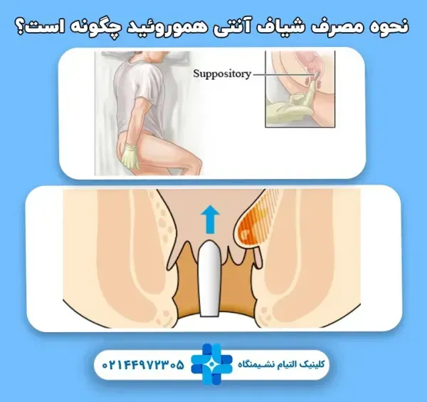  بهترین پماد آنتی هموروئید(بواسیر)