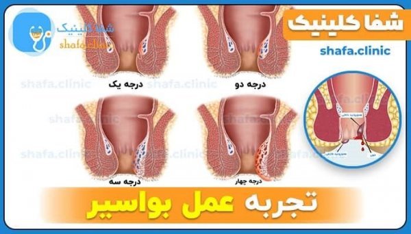  برای درمان بواسیر باید پیش چه دکتری رفت؟
