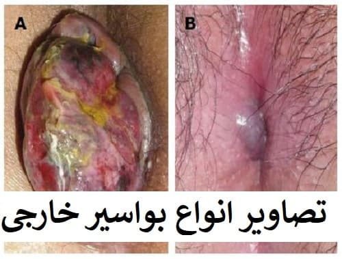  برای درمان بواسیر باید پیش چه دکتری رفت؟