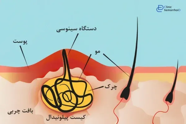  عکس و فیلم کیست مویی در کشاله ران+ زیربغل