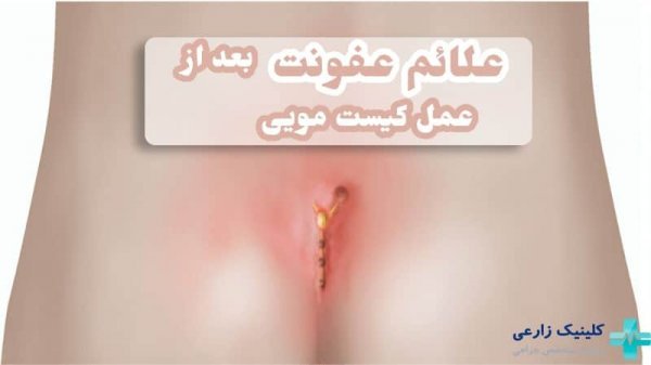  عکس و فیلم سرطان کیست مویی