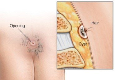  استحمام بعد از عمل کیست مویی