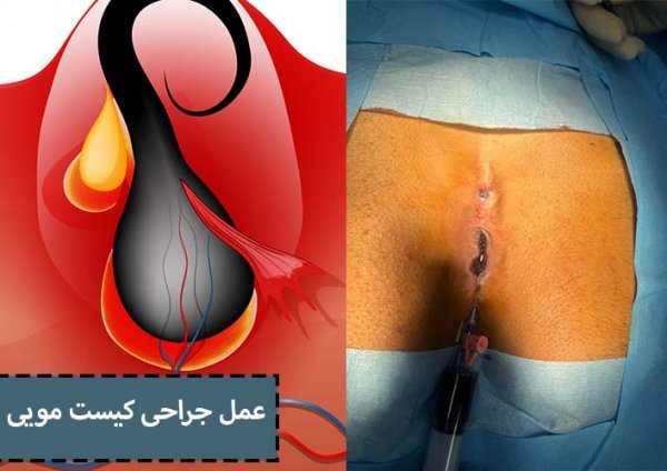  استحمام بعد از عمل کیست مویی