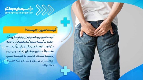  استحمام بعد از عمل کیست مویی