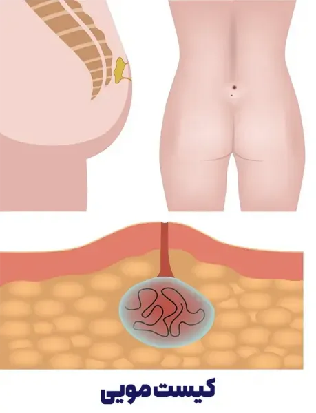  استحمام بعد از عمل کیست مویی