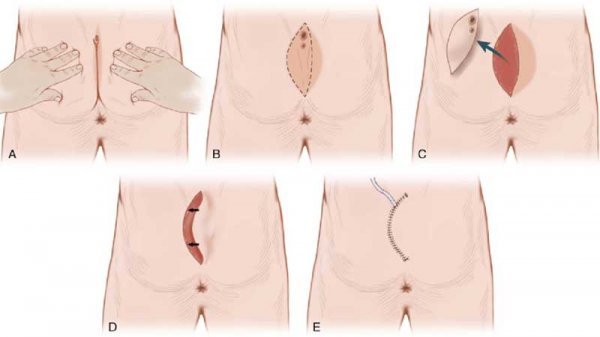  فیلم عمل کیست مویی با لیزر +مراقبت بعد از لیزر کیست مویی