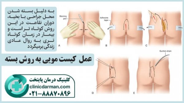  فیلم عمل کیست مویی با لیزر +مراقبت بعد از لیزر کیست مویی
