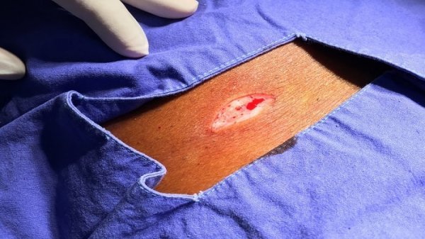 آیا عمل کیست مویی بیهوشی دارد؟