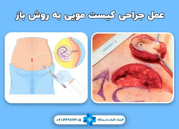  آیا عمل کیست مویی بیهوشی دارد؟