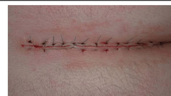  آیا عمل کیست مویی بیهوشی دارد؟