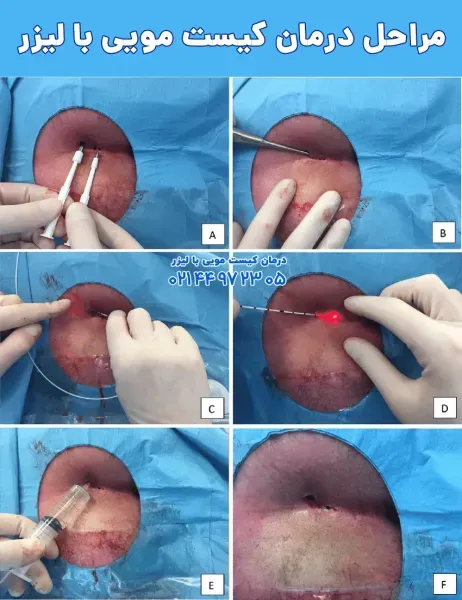  آیا عمل کیست مویی بیهوشی دارد؟