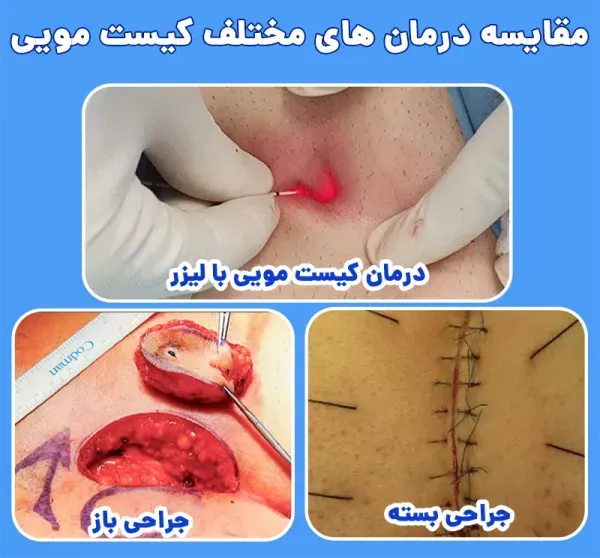  آیا عمل کیست مویی بیهوشی دارد؟