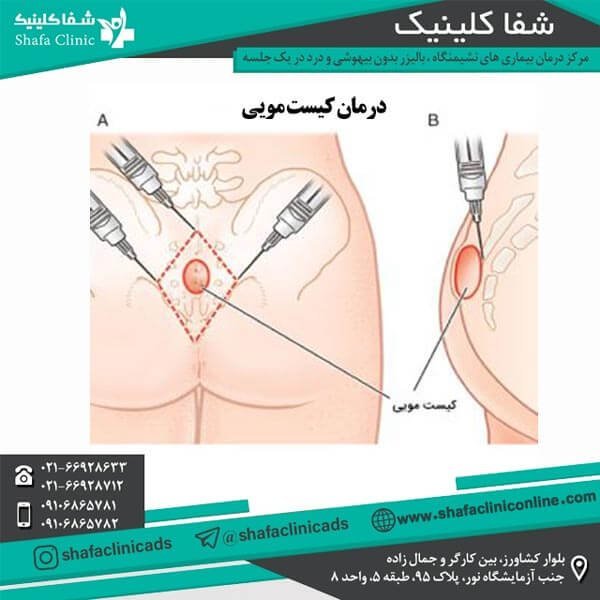  آیا عمل کیست مویی بیهوشی دارد؟