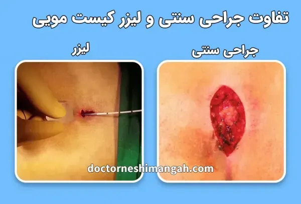عمل کیست مویی باز (سنتی) بهتر است یا لیزر