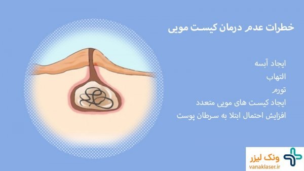  عمل کیست مویی باز (سنتی) بهتر است یا لیزر