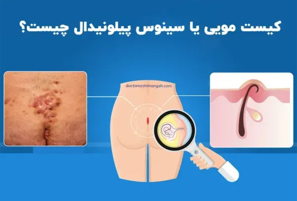  عمل کیست مویی باز (سنتی) بهتر است یا لیزر