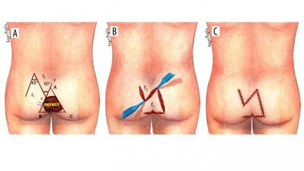  عمل کیست مویی باز (سنتی) بهتر است یا لیزر