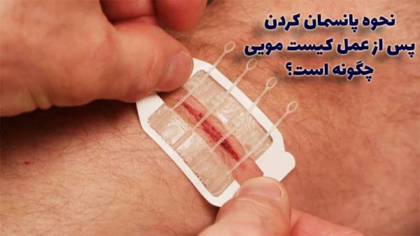  عمل کیست مویی باز (سنتی) بهتر است یا لیزر