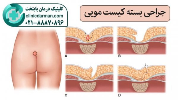  عکس و فیلم کیست مویی زنان + علت کیست مویی