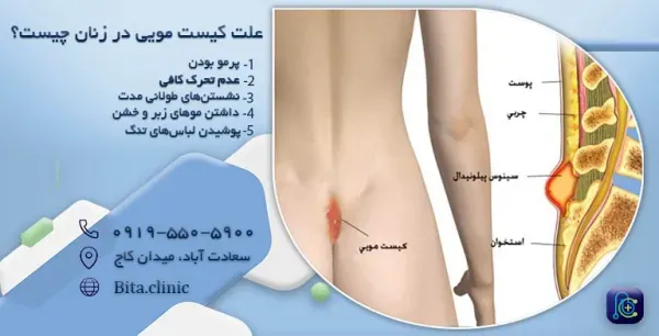  عکس و فیلم کیست مویی زنان + علت کیست مویی