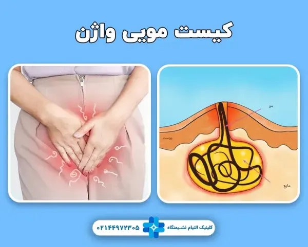  عکس و فیلم کیست مویی زنان + علت کیست مویی