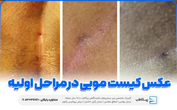  عکس و فیلم کیست مویی زنان + علت کیست مویی