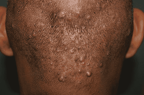 کیست مویی بعد از کاشت مو