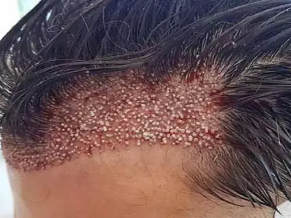  کیست مویی بعد از کاشت مو