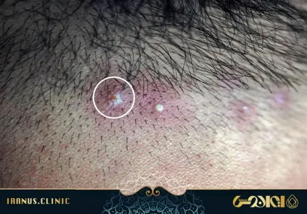  کیست مویی بعد از کاشت مو