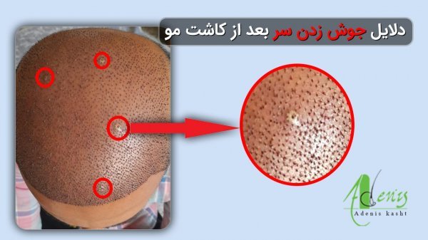  کیست مویی بعد از کاشت مو